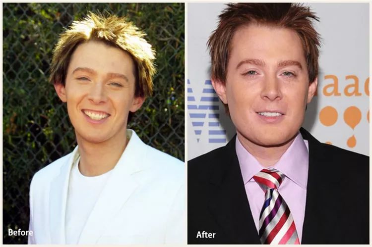 14個光速衰老的好萊塢明星今昔大對比，整形卻整的更壞