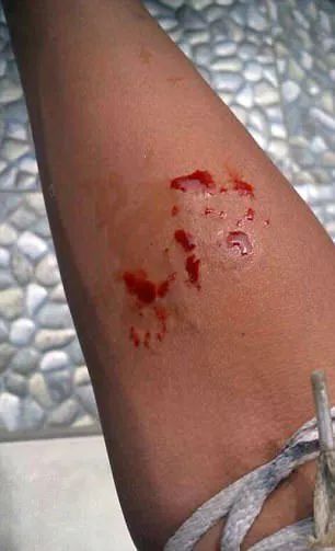 14歲少年被自己眼鏡王蛇咬到拍照炫耀，12小時后慘死