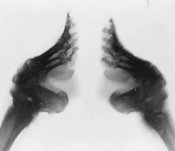 古代傳統極端纏足文化照片，X光看起來太可怕！