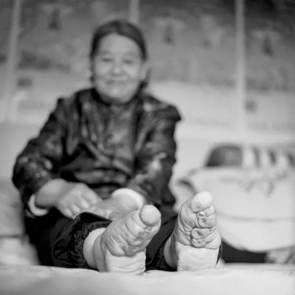 古代傳統極端纏足文化照片，X光看起來太可怕！